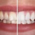 Teeth Whitening