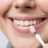 Veneers