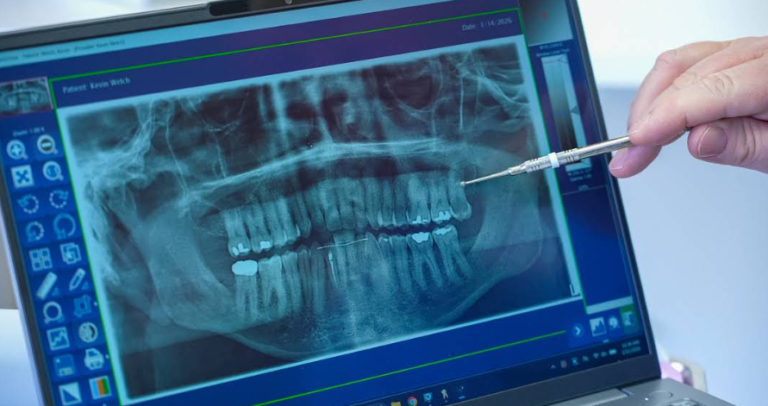 tooth extraction